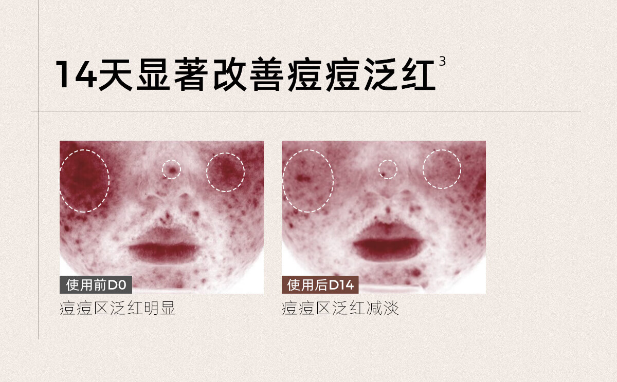 C咖祛痘双管氨基酸洁面乳男女洗面奶白泥祛痘控油清洁毛孔护肤品 祛痘控油双管洗面奶80g*1支