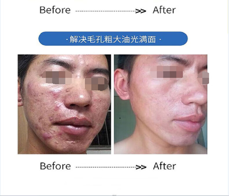 广药白云山氨基酸洗面奶痘痘黑头粉刺控油收缩毛孔深层清洁500ml