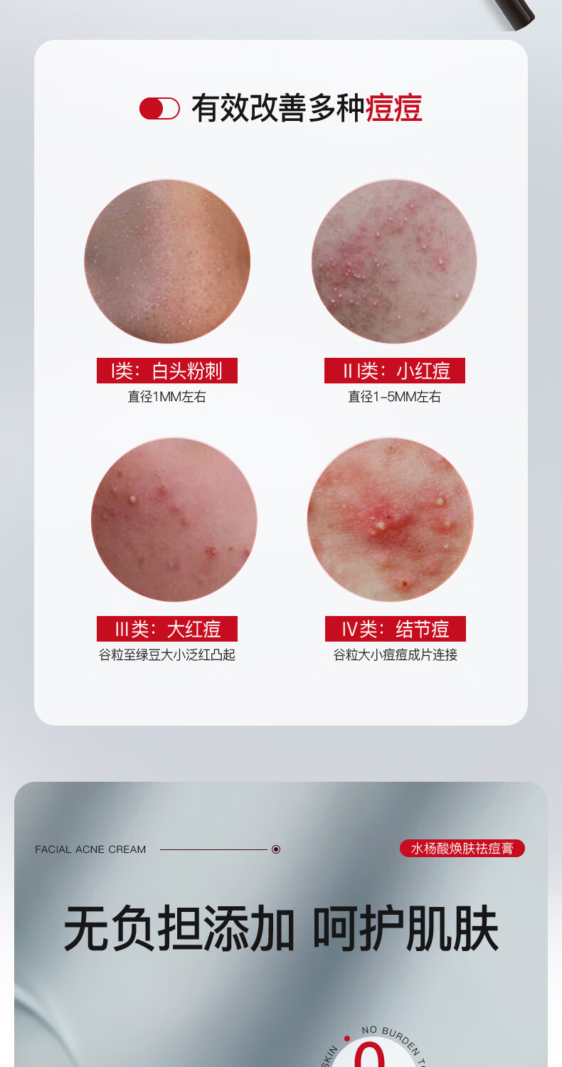氧诗恋水杨酸焕肤祛痘膏修护淡化痘痘印去痘和痘印修护痘坑闭口粉刺50g