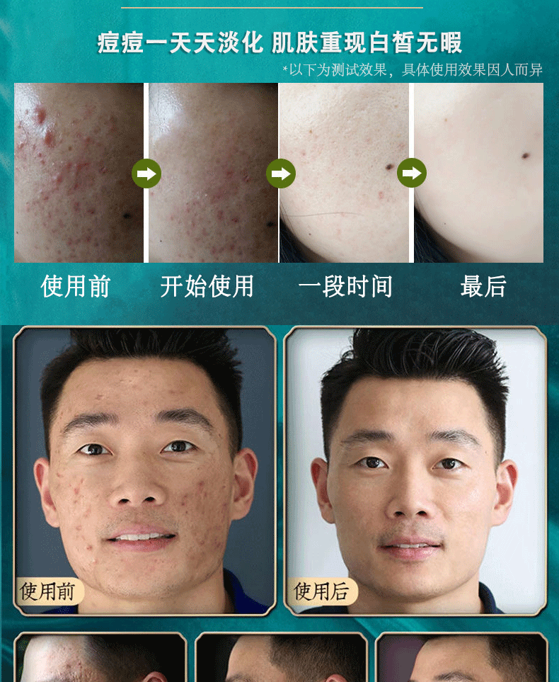 南京同仁堂祛痘膏痘疤痘坑痘痘肌呵护青春红肿痘闭口粉刺芦荟胶30g