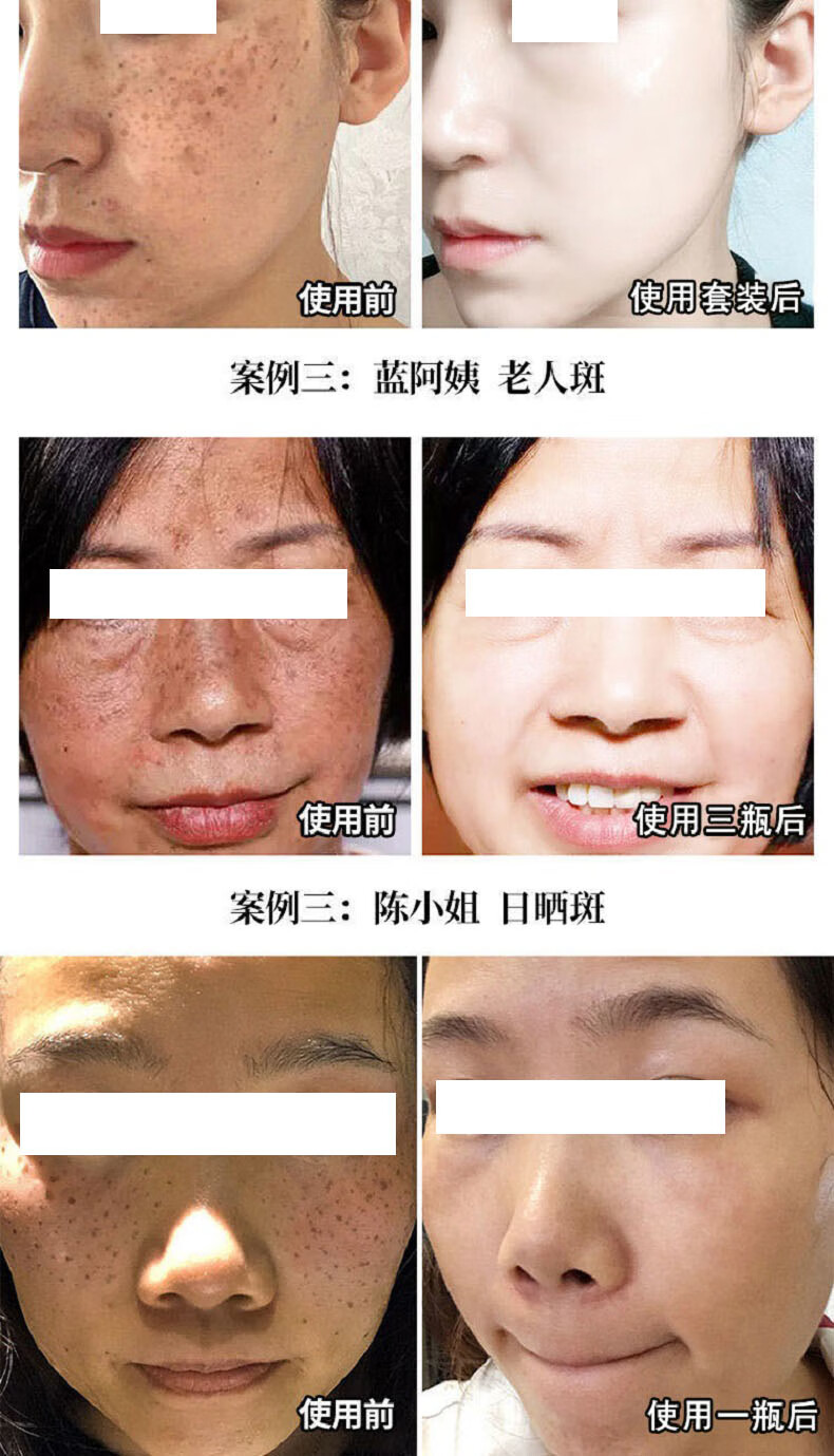 白云山美白祛斑精华液祛斑产品男女烟酰胺去黄淡化去斑溶斑油100ml