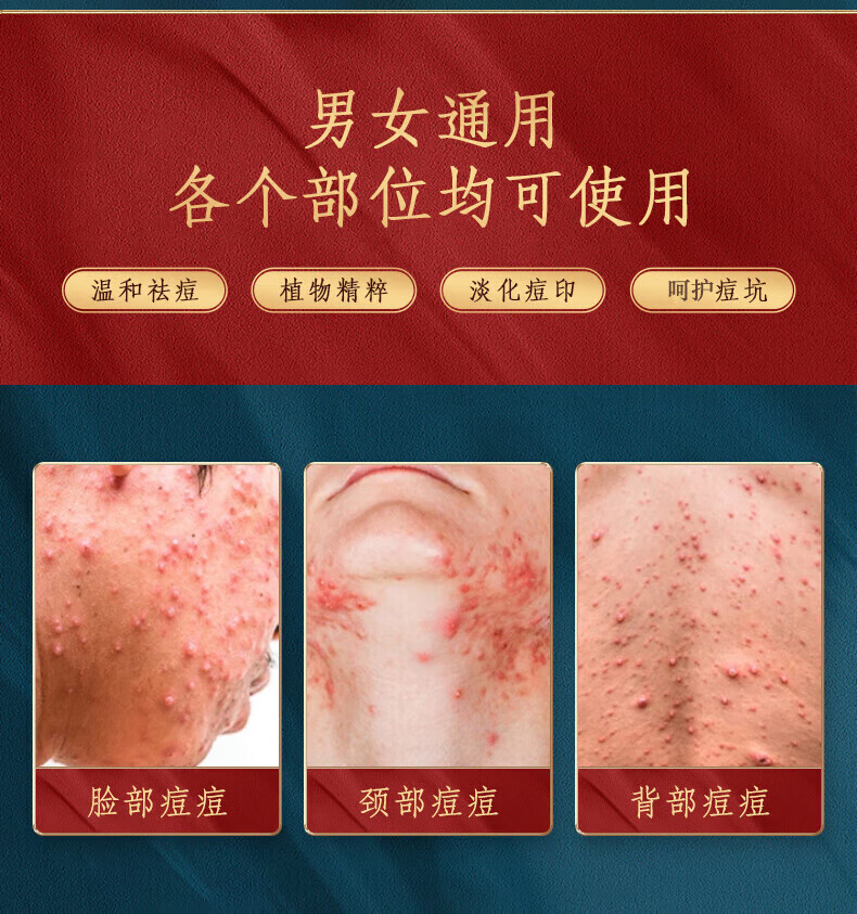 百幽草南京同仁堂水杨酸祛痘膏痘印淡化痘印痘坑修复学生男女青春痘30g