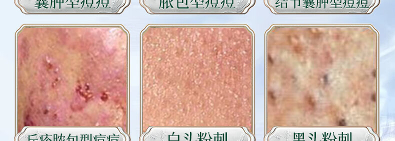 同仁堂祛痘膏淡化痘印痘坑修复男女士改善粉刺闭口去痘痘和痘印