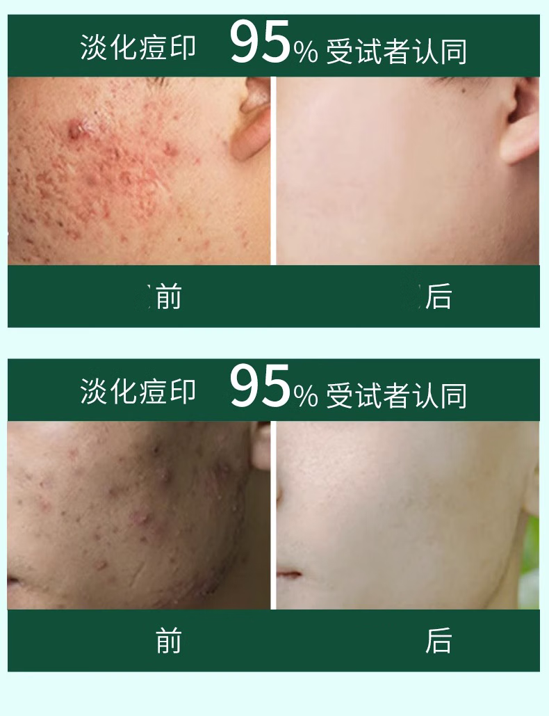 NHFOUYOU祛痘精华液修复淡化痘印痘坑青春痘祛痘疤闭口收缩毛孔油痘女男士 1瓶【体验装】30ml