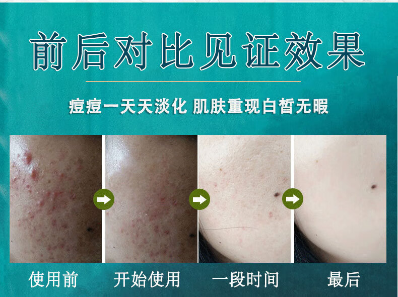 同仁堂祛痘膏去痘疤淡化痘印痘坑修复呵护痘肌亮肤舒缓青春痘20g