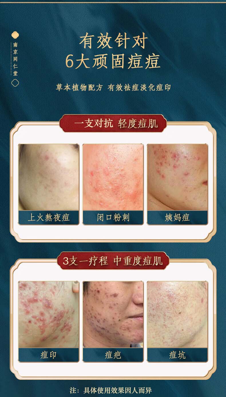 百幽草南京同仁堂水杨酸祛痘膏痘印淡化痘印痘坑修复学生男女青春痘30g