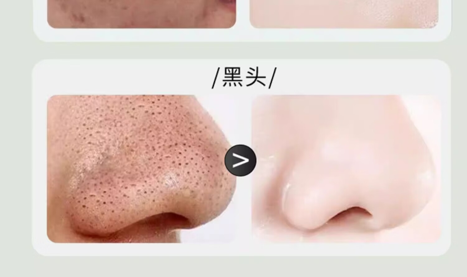 丽可植小绿瓶祛痘精华液痘印淡化痘印祛痘祛黑头收缩毛孔闭口粉刺霜 【1瓶】祛痘体验装