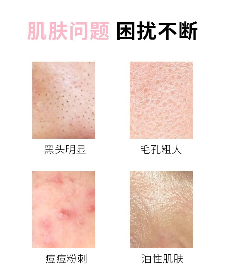 翼颜壬二酸15%凝胶水杨酸细致毛孔霜软膏清痘凝露黑头粉刺乳膏30g 1套