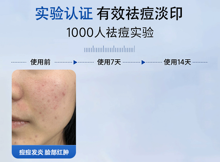 草萨草本祛痘膏消痘印清痘膏淡化痘印男士去痘疤痘坑修复学生青春痘