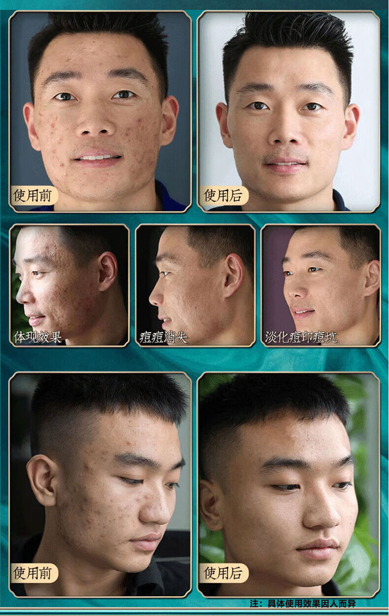 同仁堂祛痘膏去痘疤淡化痘印痘坑修复呵护痘肌亮肤舒缓青春痘20g
