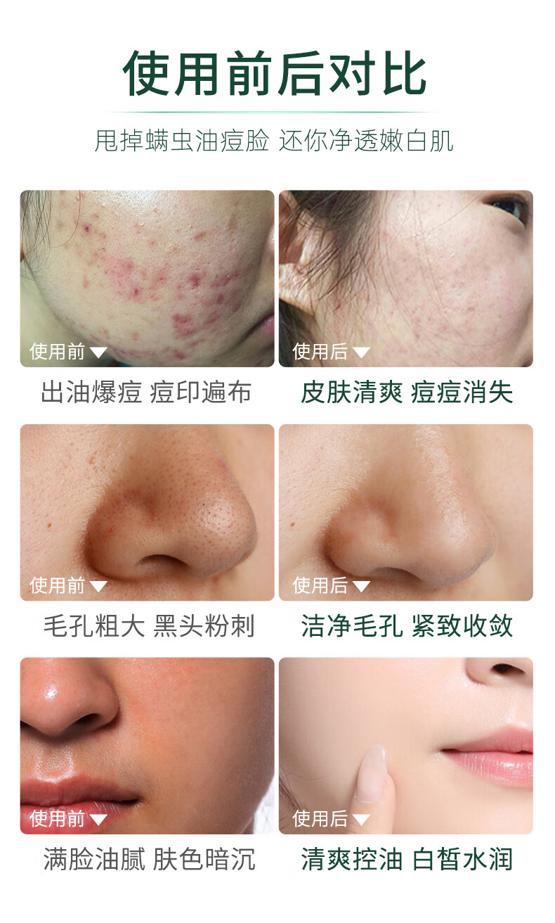 BAINHR水杨酸洗面奶南方医科大学清爽控油缓解痘痘肌深层清洁收缩毛孔