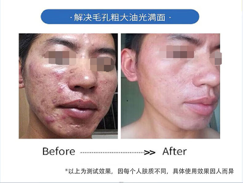 白云山氨基酸洗面奶痘痘角质黑头粉刺控油收缩毛孔深层清洁500ml