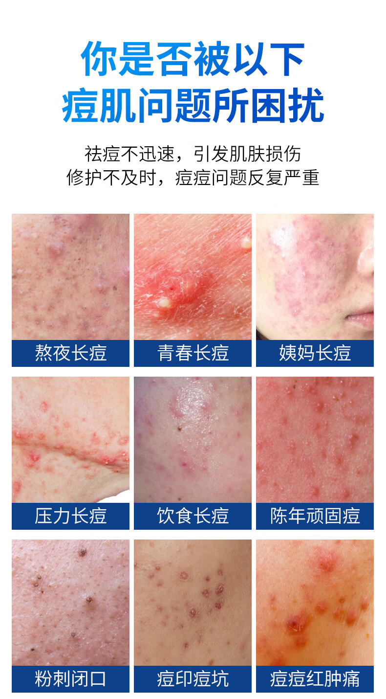 仁和匠心祛痘膏亮肤水杨酸印祛痘去痘男女士祛痘凝胶芦荟胶淡化痘印痘坑修护中大学生青春痘闭口粉刺30ml