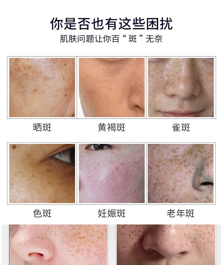 白云山星群 美白祛斑霜溶斑断黑霜淡化斑老年斑雀斑黄褐斑男女士去斑产品30g