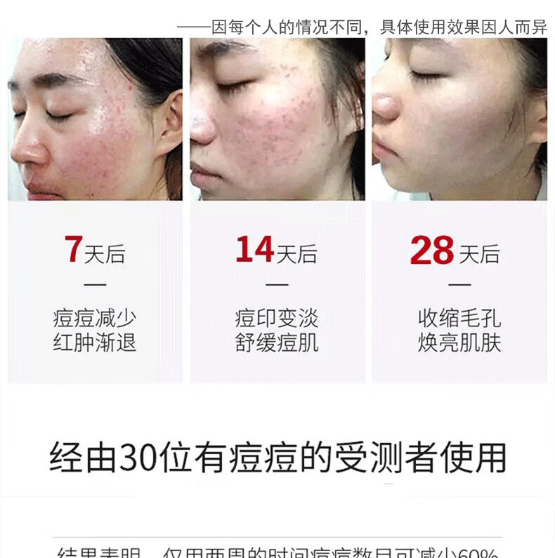 南京同仁堂芦荟祛痘膏祛痘凝胶闭口去淡化痘印痘肌复修男女青春痘学生20g/瓶