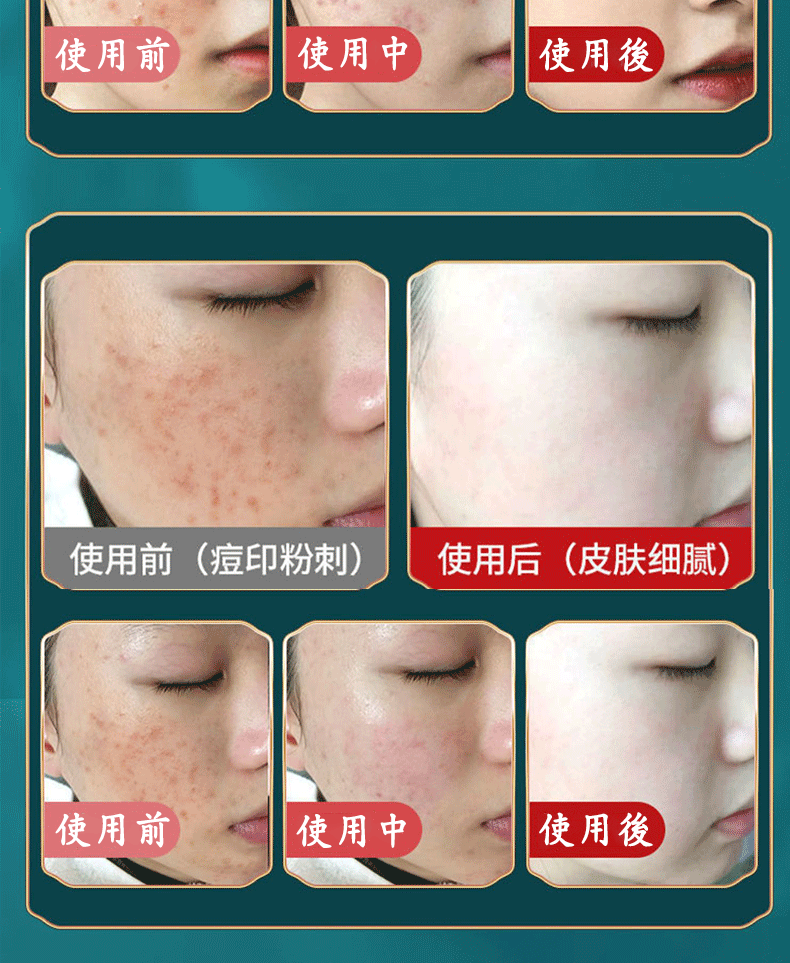 南京同仁堂祛痘膏淡化痘印痘疤痘坑呵护痘肌青春痘