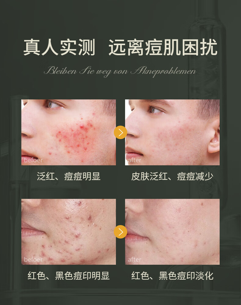 SKISGEM 德国进口祛痘精华膏淡化痘印痘坑修复凝胶芦荟胶女男士 【轻度痘痘】祛痘修复膏/30g