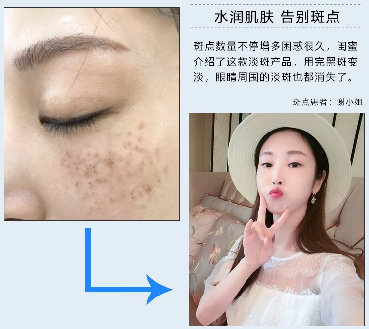 NHFOUYOU祛斑精华油点黑点玫瑰净颜精油补水美白提亮肤色溶斑精华美白淡斑 1瓶【体验装】