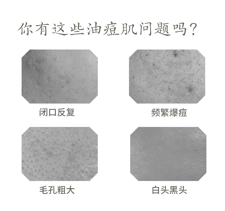 京东京造 水杨酸祛痘凝胶20g 祛痘膏精华净痘减少闭口改善痘痘黑头