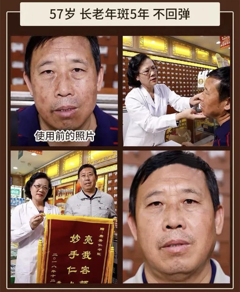碧索娜（BISUONA）南京同仁堂美白祛斑霜去斑霜去雀斑老年斑晒斑黑斑黄褐斑妊娠斑淡化男女士面部祛斑产品30g
