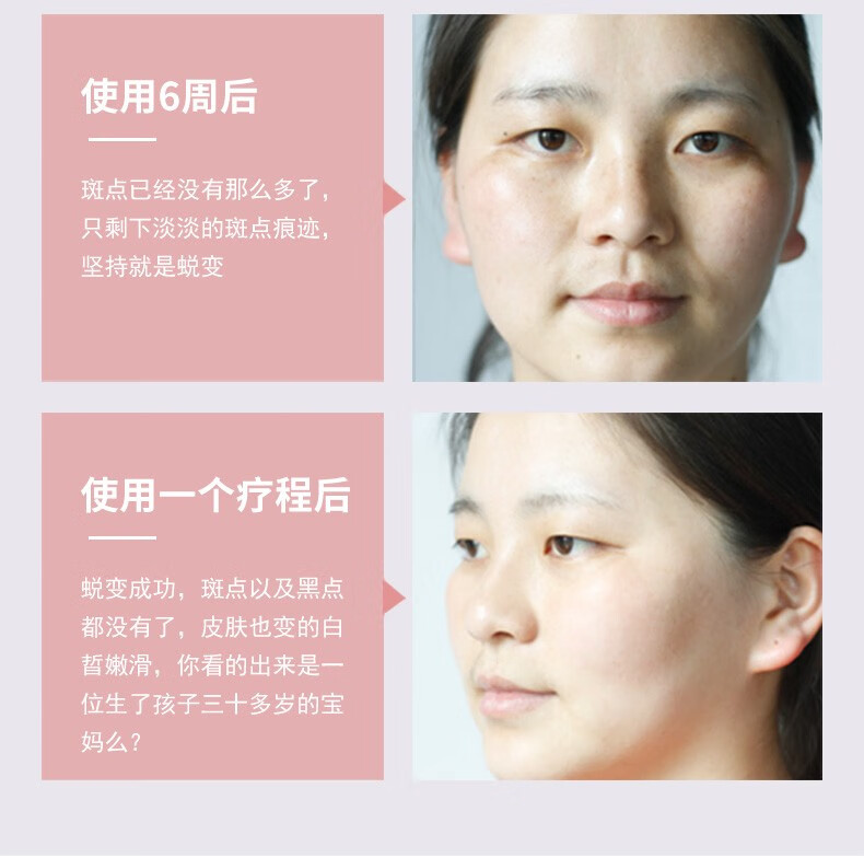 NHFOUYOU祛斑精华油点黑点玫瑰净颜精油补水美白提亮肤色溶斑精华美白淡斑 1瓶【体验装】