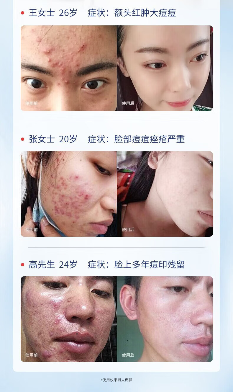 宫本武藏祛痘膏去痘痘面霜修复痘印痘坑淡化青春痘男女学生闭口粉刺10g