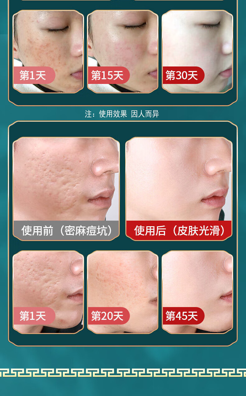 同仁堂（TRT）祛痘膏痘印去痘疤淡化痘印痘坑修复痘肌青春痘20g