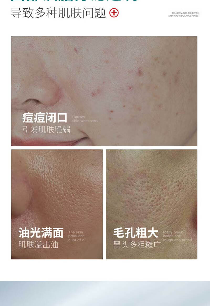 珂卡薇祛痘精华液次抛去痘痘印淡化舒缓补水闭口壬二酸水杨酸精华10支