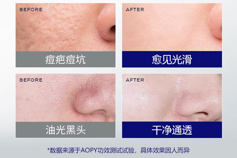AOPY草本净颜祛痘膏修护青春痘祛痘闭口粉刺痘印痘坑学生青春痘30g