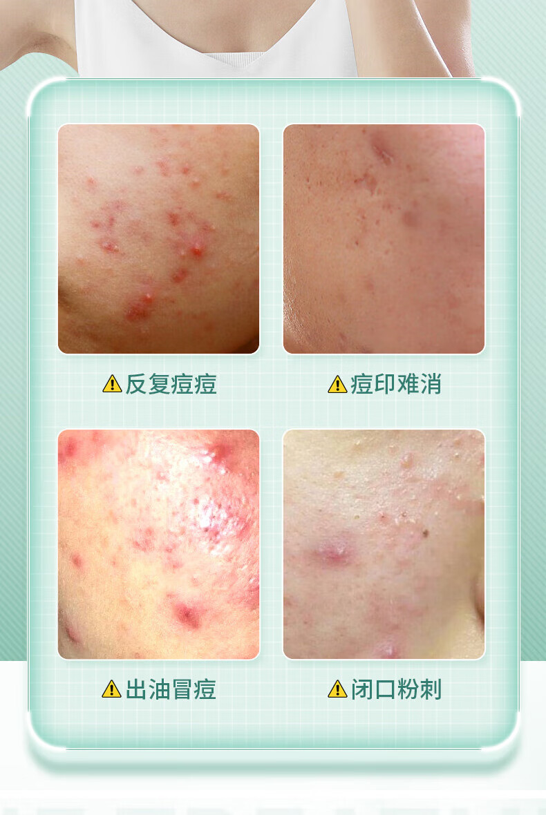 同仁堂祛痘膏淡化痘印痘疤痘坑修护痘肌闭口粉刺青春痘去痘痘和痘印20g