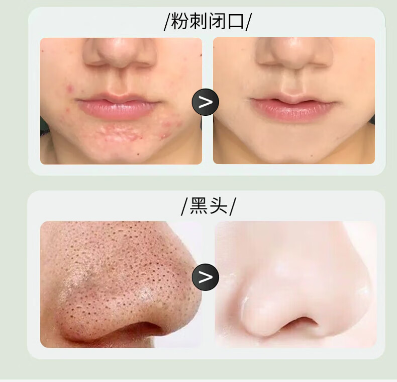 丽可植小绿瓶精华液消痘印淡化消印痘坑痘疤收缩毛孔闭口粉刺面部护肤 【2瓶】巩固装+面膜1片