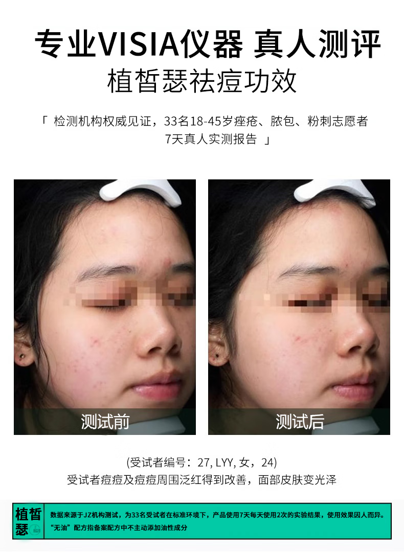 植皙瑟壬二酸祛痘控油精华液控油去痘闭口粉刺痘印痘坑舒缓提亮肤色5支