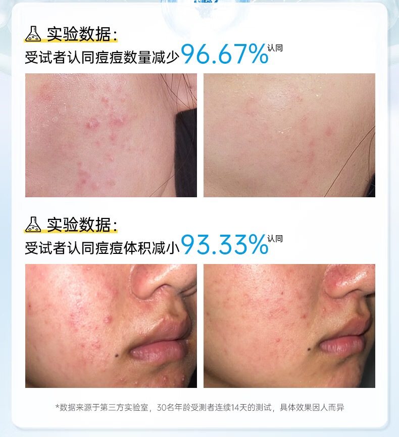 透真清颜水杨酸祛痘修护舒缓凝胶控油淡化痘印痘坑20g