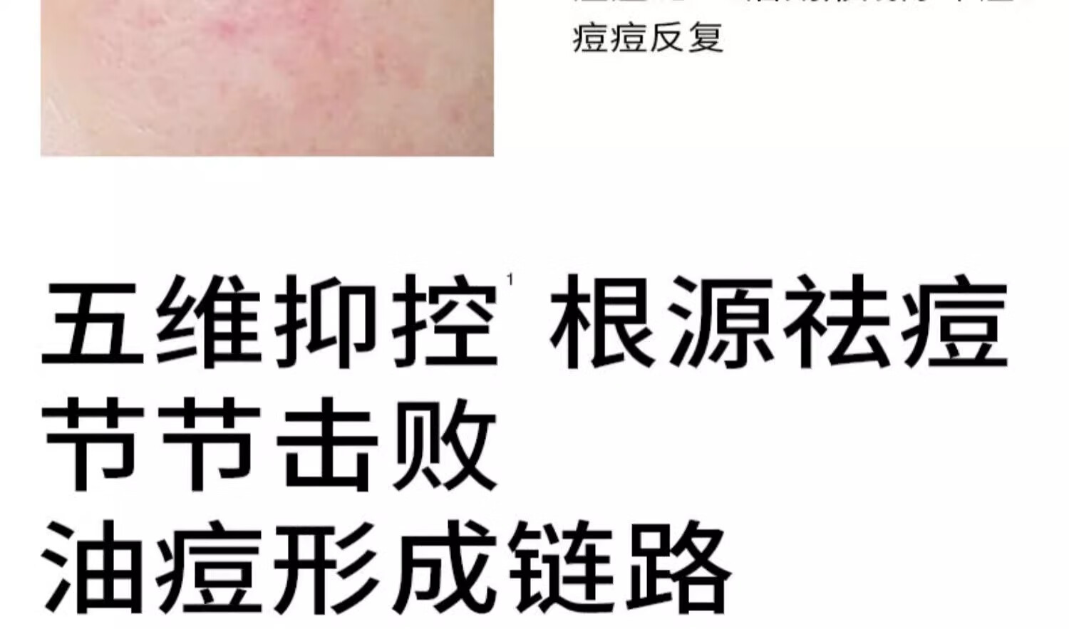 PMPM深海鱼雷祛痘精华液油皮改善泛红收缩毛孔15ml送男友礼物