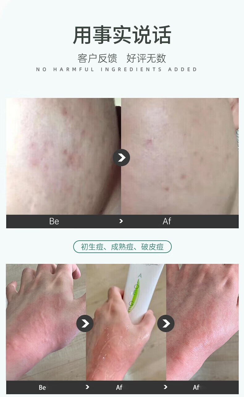 AMC南非芦荟胶啫喱淡化痘印补水保湿晒后修肤滋润 蚊虫叮咬  75ml