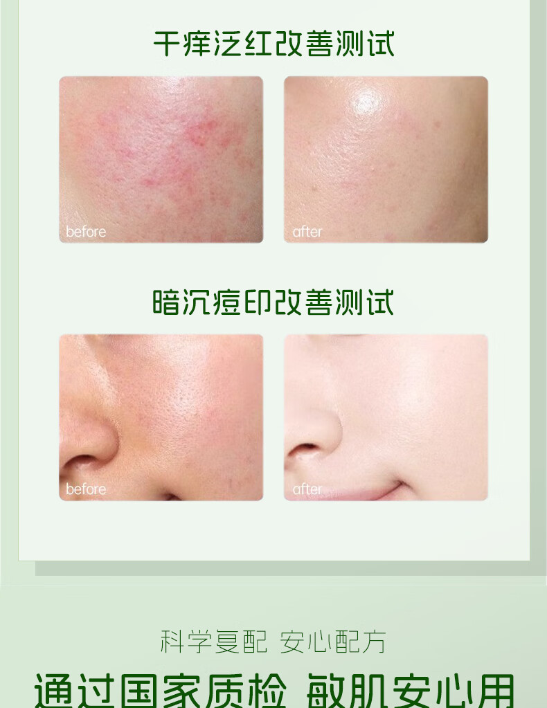 臻羞芦荟胶祛痘淡化痘印舒缓呵护晒后修复肌肤补水保湿男女60g