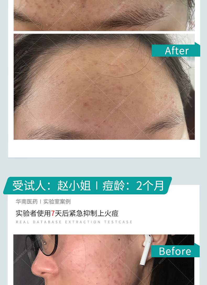 ANFANY痘痘点涂棒精华液水杨酸修护痘改善肌闭口粉刺痘印痘坑20支/盒