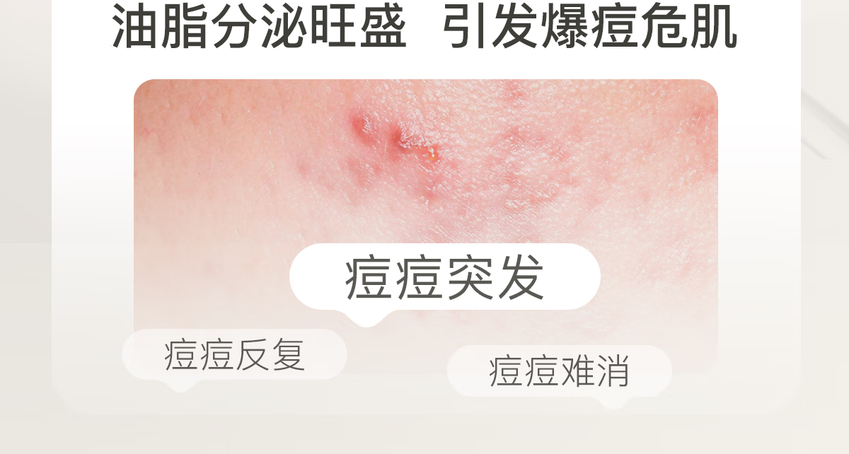 悦芙媞【会员专享】点痘精华3g尝鲜快速瘪痘修护舒缓淡红印控油祛痘精华