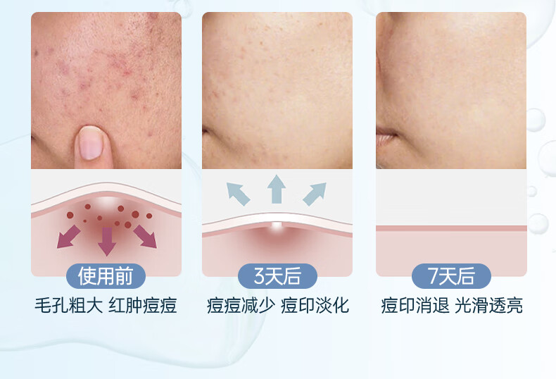 OHBT水杨酸精华液改善黑头闭口细致毛孔焕白靓白补水保湿淡化细纹呵护 【镇静舒缓】祛痘精华液50ml*2