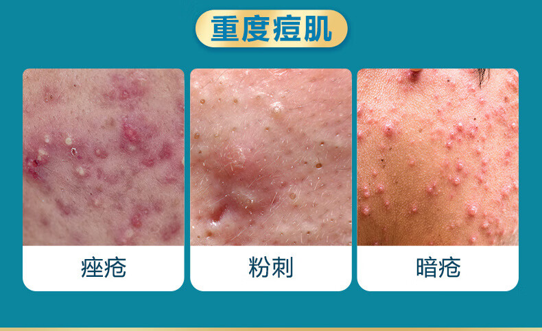 广药白云山草本祛痘膏去痘膏痘疤痘坑青春痘闭口粉刺痘痘膏男女学生