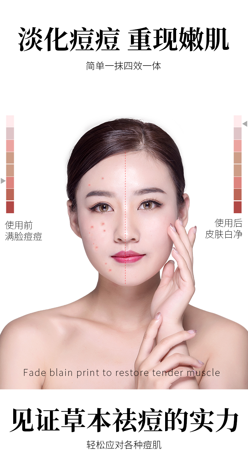 倩滋（QIANZI）草本祛痘膏30g 淡化痘印男士女士修护痘肌 青春痘闭口粉刺痘坑痘疤去痘精华