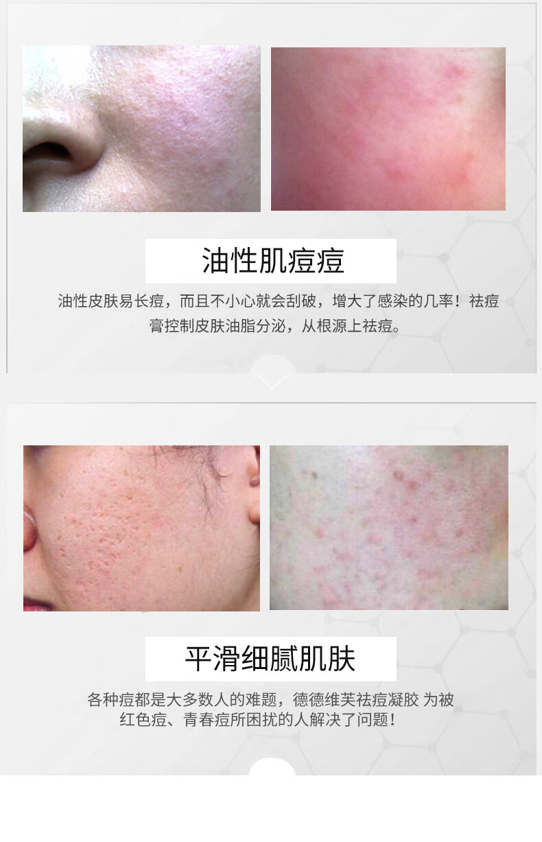 德德维芙（DETVFO）壬二酸15%凝胶配水杨酸细致毛孔霜祛痘膏印黑头闭口粉刺套装20g*2