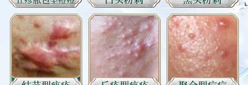 同仁堂祛痘膏淡化痘印痘坑修复男女士改善粉刺闭口去痘痘和痘印