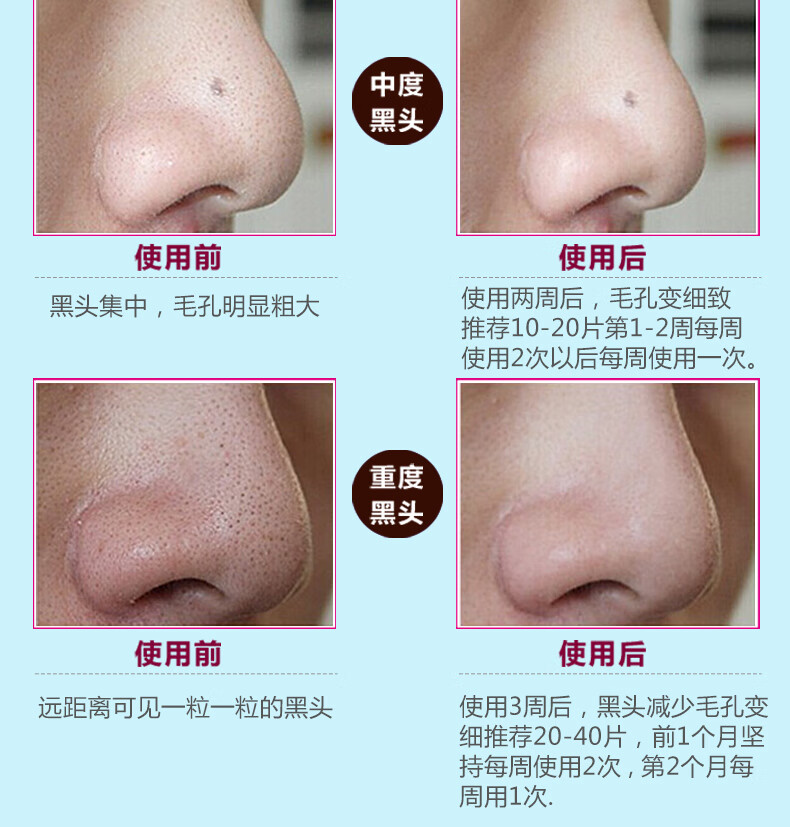 玛贝拉mayllie去黑头鼻贴5p(撕拉式鼻贴膜套装T区护理收缩毛孔男女可用)