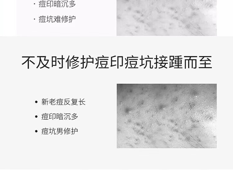 南京同仁堂芦荟祛痘膏祛痘凝胶闭口去淡化痘印痘肌复修男女青春痘学生20g/瓶
