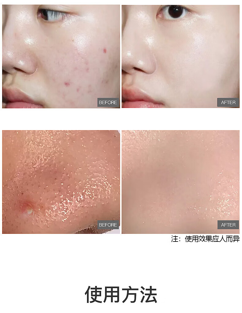 韩伦美羽水杨酸棉片刷痘肌酸清痘闭口粉刺黑头疏通清洁毛孔抗痘痘水杨酸控油温和不含酒精55片