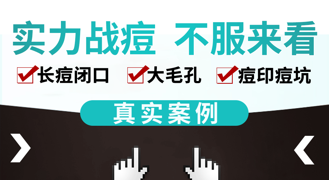 御菲棠祛痘净肤次抛精华液印修复淡化痘印痘坑闭口粉刺收缩毛孔补水保湿