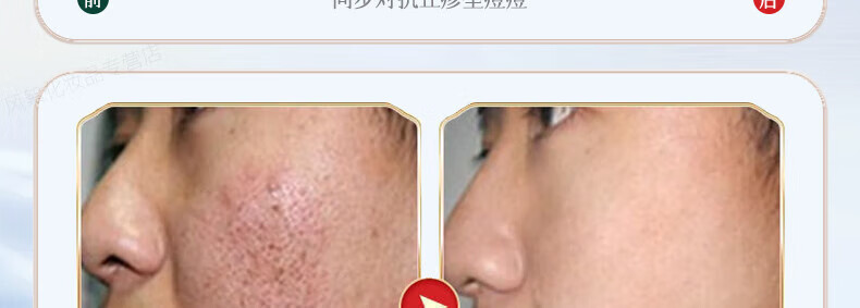 同仁堂祛痘膏淡化痘印痘坑修护男女士改善粉刺闭口去痘痘和痘印20g