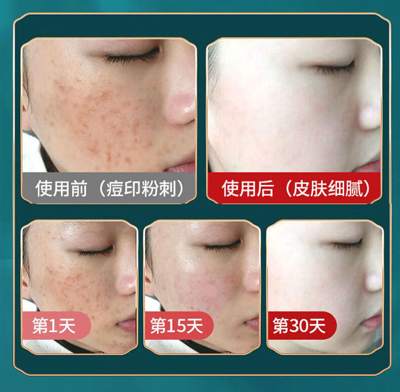 同仁堂祛痘膏去痘疤淡化痘印痘坑修复呵护痘肌亮肤舒缓青春痘20g