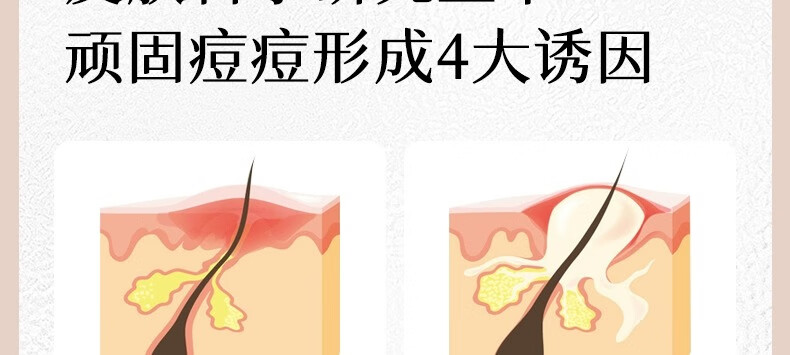 ORGINESE欧橘水杨酸果酸水滴精华液熬夜刷可搭祛痘淡化痘印20ml情人节